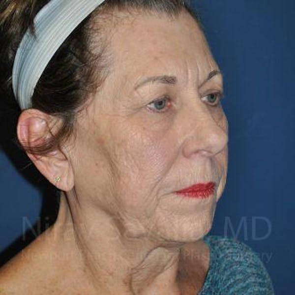 Fat Grafting to Face Before & After Gallery - Patient 1655716 - Before