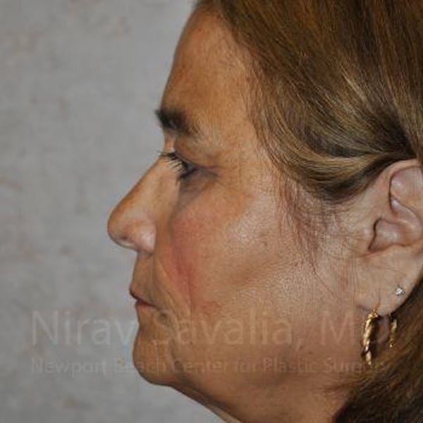 Fat Grafting to Face Before & After Gallery - Patient 1655719 - Before