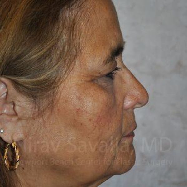 Fat Grafting to Face Before & After Gallery - Patient 1655719 - Before