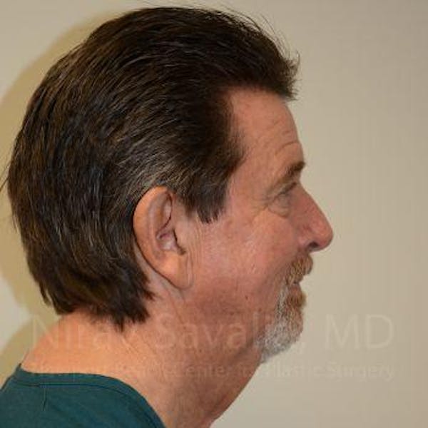 Eyelid Surgery Before & After Gallery - Patient 1655720 - Before