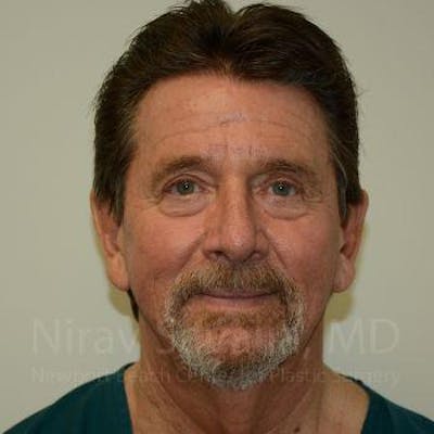 Male Breast Reduction Before & After Gallery - Patient 1655726 - After