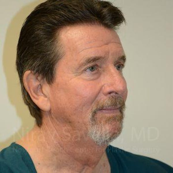 Male Breast Reduction Before & After Gallery - Patient 1655726 - Before