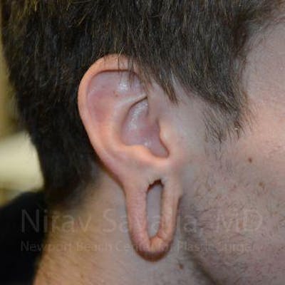 Torn Earlobe Repair Ear Gauge Repair Before & After Gallery - Patient 1655788 - Before