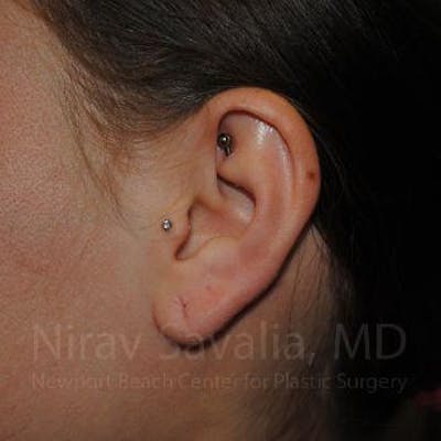 Torn Earlobe Repair Ear Gauge Repair Before & After Gallery - Patient 1655798 - Before