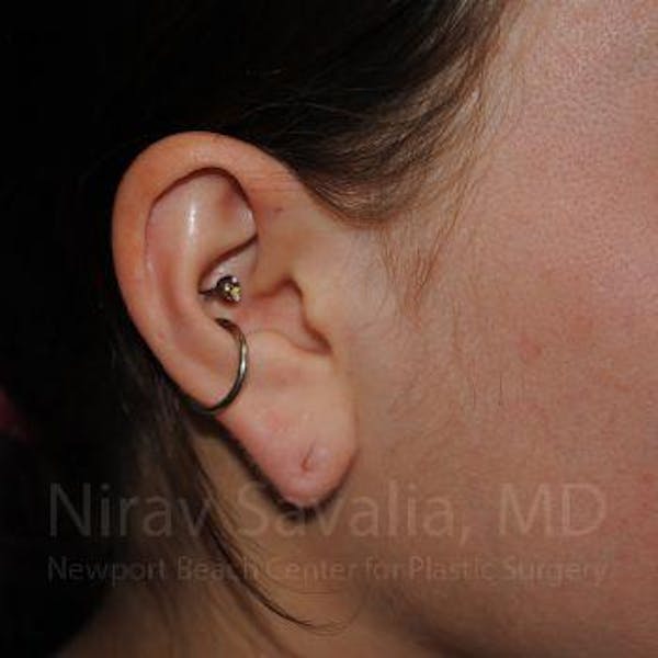 Torn Earlobe Repair Ear Gauge Repair Before & After Gallery - Patient 1655798 - Before