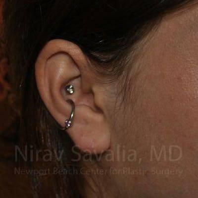 Torn Earlobe Repair Ear Gauge Repair Before & After Gallery - Patient 1655798 - After