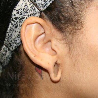 Torn Earlobe Repair Ear Gauge Repair Before & After Gallery - Patient 1655800 - Before