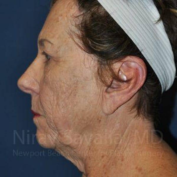 Fat Grafting to Face Before & After Gallery - Patient 1655802 - Before