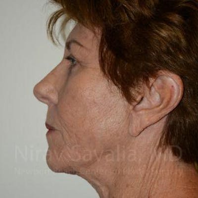 Fat Grafting to Face Before & After Gallery - Patient 1655802 - After