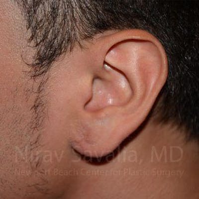 Torn Earlobe Repair Ear Gauge Repair Before & After Gallery - Patient 1655801 - After