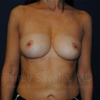 Breast Lift without Implants Before & After Gallery - Patient 1655454 - Image 2