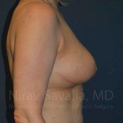 Breast Reduction Before & After Gallery - Patient 1655461 - After