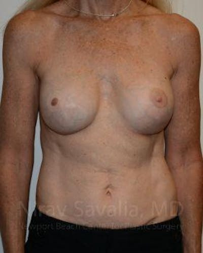 Fat Grafting to Face Before & After Gallery - Patient 1655466 - After