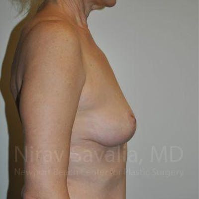 Male Breast Reduction Before & After Gallery - Patient 1655472 - After