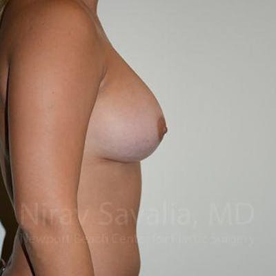 Abdominoplasty Tummy Tuck Before & After Gallery - Patient 1655477 - After