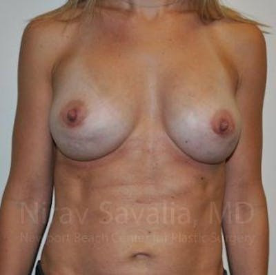 Breast Reduction Before & After Gallery - Patient 1655478 - After