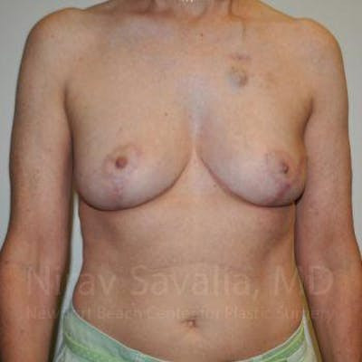 Mastectomy Reconstruction Revision Before & After Gallery - Patient 1655487 - After