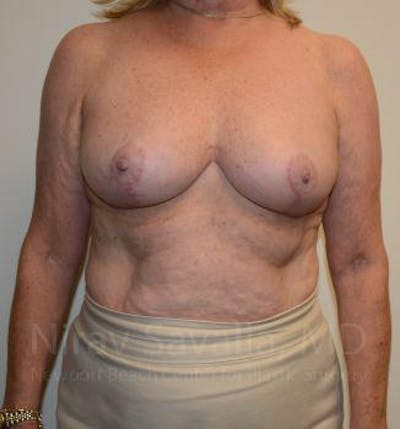 Breast Reduction Before & After Gallery - Patient 1655496 - After