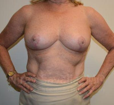 Mastectomy Reconstruction Before & After Gallery - Patient 1655496 - After