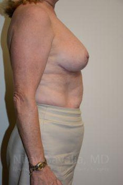 Breast Reduction Before & After Gallery - Patient 1655496 - After