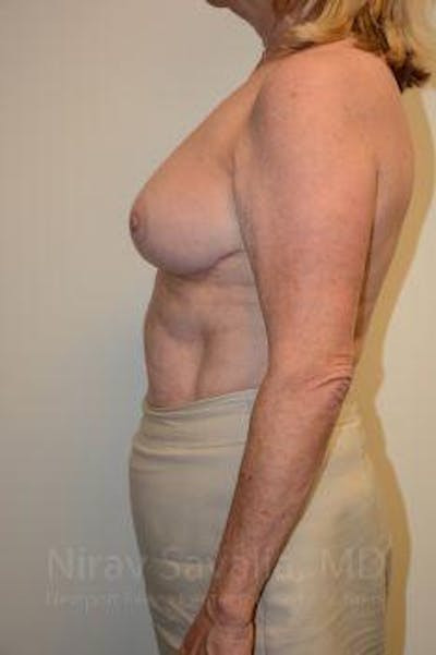 Mastectomy Reconstruction Before & After Gallery - Patient 1655496 - After