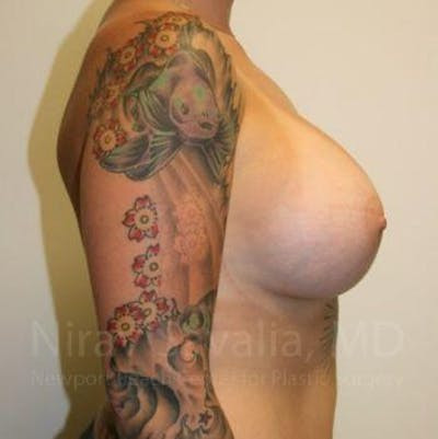 Breast Reduction Before & After Gallery - Patient 1655500 - After