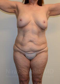 Breast Lift without Implants Before & After Gallery - Patient 1655509 - Image 1