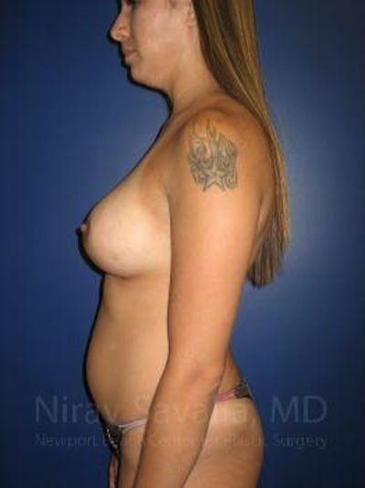 Male Breast Reduction Before & After Gallery - Patient 1655508 - After