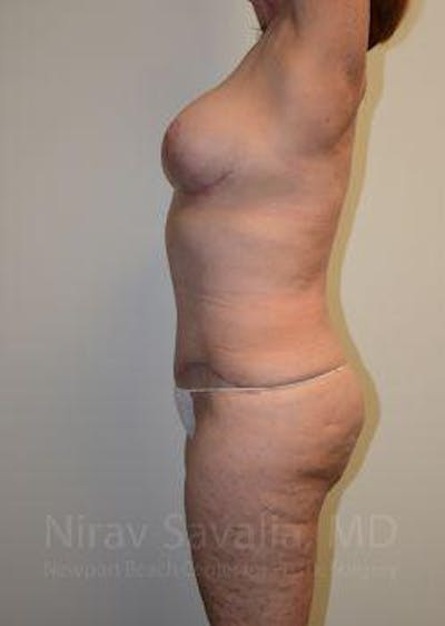 Breast Reduction Before & After Gallery - Patient 1655509 - After