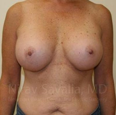 Male Breast Reduction Before & After Gallery - Patient 1655519 - After