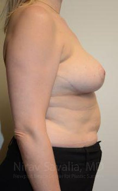 Fat Grafting to Face Before & After Gallery - Patient 1655516 - After