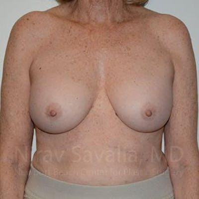 Liposuction Before & After Gallery - Patient 1655520 - After