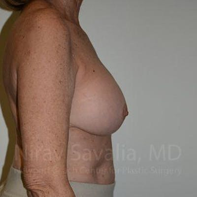 Liposuction Before & After Gallery - Patient 1655520 - After