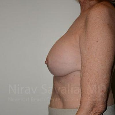 Liposuction Before & After Gallery - Patient 1655520 - After