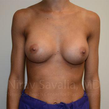 Breast Lift without Implants Before & After Gallery - Patient 1655548 - After