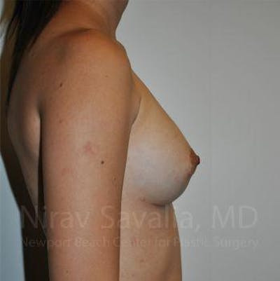 Body Contouring after Weight Loss Before & After Gallery - Patient 1655564 - After