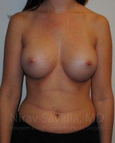 Male Breast Reduction Before & After Gallery - Patient 1655574 - After