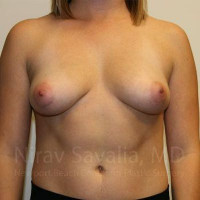 Breast Augmentation Before & After Gallery - Patient 1655593 - Image 1