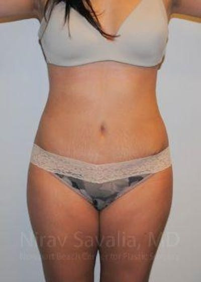 Breast Lift without Implants Before & After Gallery - Patient 1655598 - After