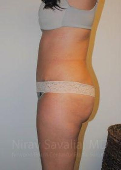 Breast Lift without Implants Before & After Gallery - Patient 1655598 - After