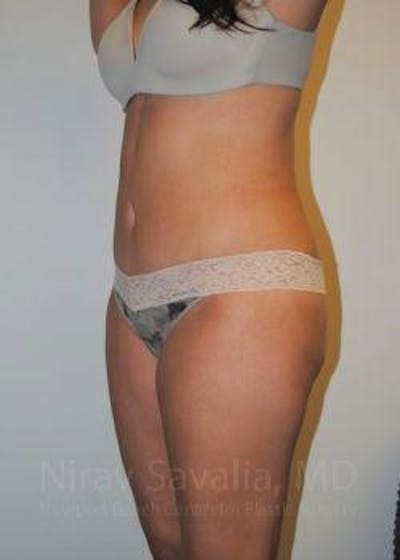 Abdominoplasty Tummy Tuck Before & After Gallery - Patient 1655599 - After