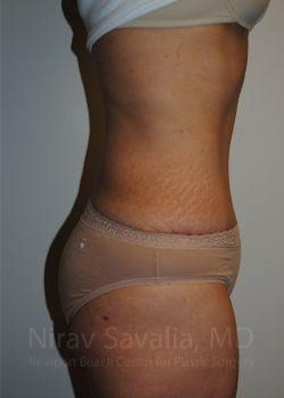 Fat Grafting to Face Before & After Gallery - Patient 1655601 - After