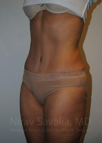 Breast Reduction Before & After Gallery - Patient 1655601 - After