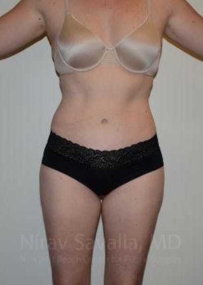 Male Breast Reduction Before & After Gallery - Patient 1655603 - After