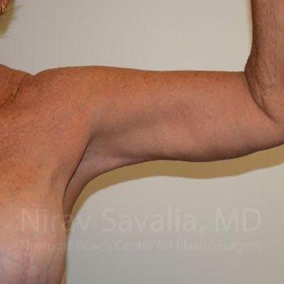 Arm Lift Before & After Gallery - Patient 1655602 - After