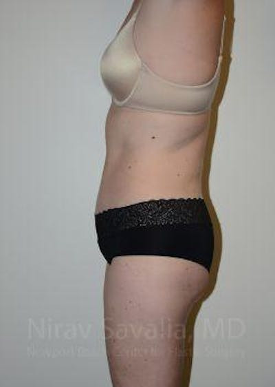 Breast Lift without Implants Before & After Gallery - Patient 1655605 - After