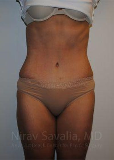 Liposuction Before & After Gallery - Patient 1655608 - After