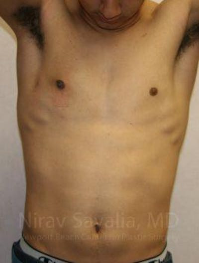 Male Breast Reduction Before & After Gallery - Patient 1655607 - After