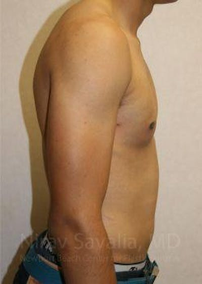 Breast Lift without Implants Before & After Gallery - Patient 1655607 - After