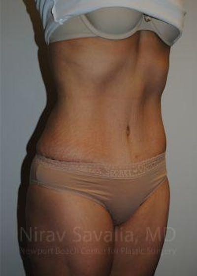 Liposuction Before & After Gallery - Patient 1655608 - After